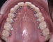 ortodonzia_linguale_1