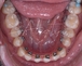 ortodonzia_linguale_2