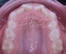 Interceptive Orthodontics for Children - Growth and Prevention | Dr. Albertini Reggio Emilia